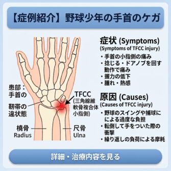 TFCC損傷の説明をしているイラスト